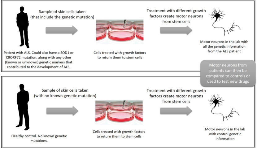 Amyotrophic Lateral Sclerosis Limb Onset