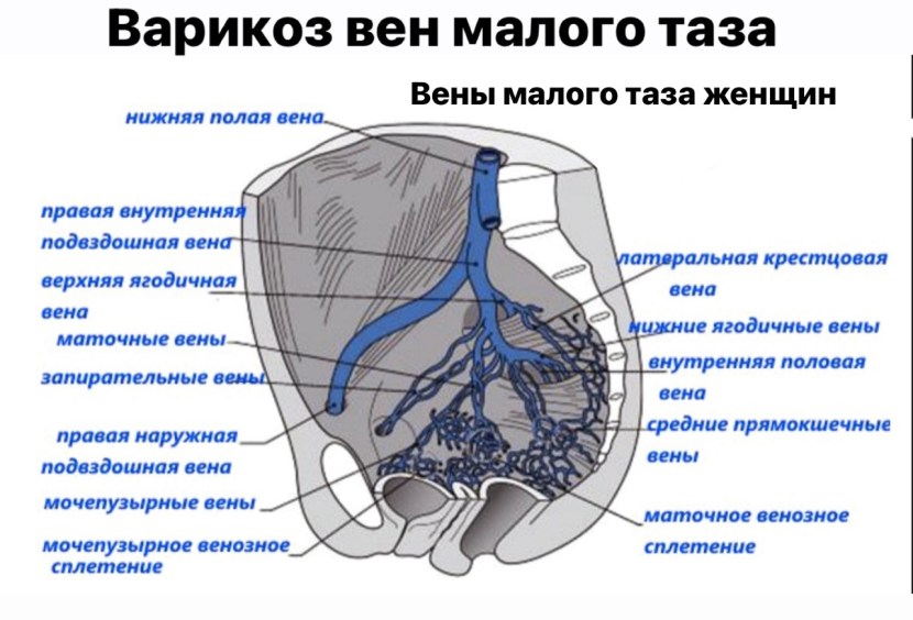 Inner iliac vein of tributaries