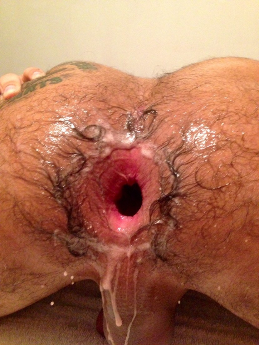 Blagless male anus