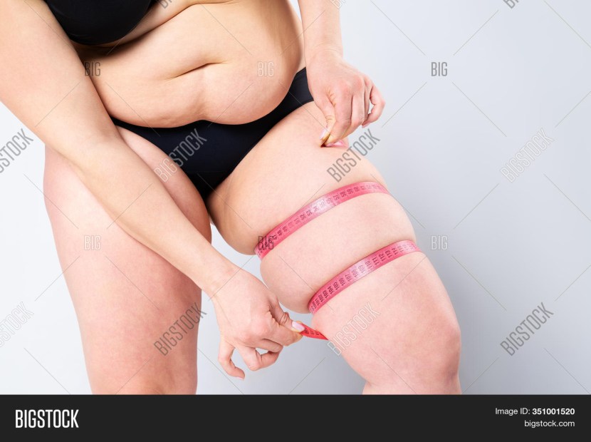 Excess weight of obesity cellulite