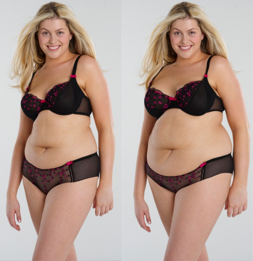 Huge hanging stomach