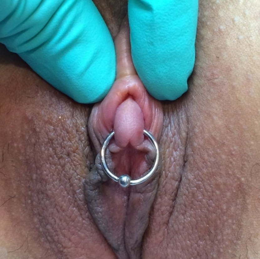 Huge clitoris of a virgin