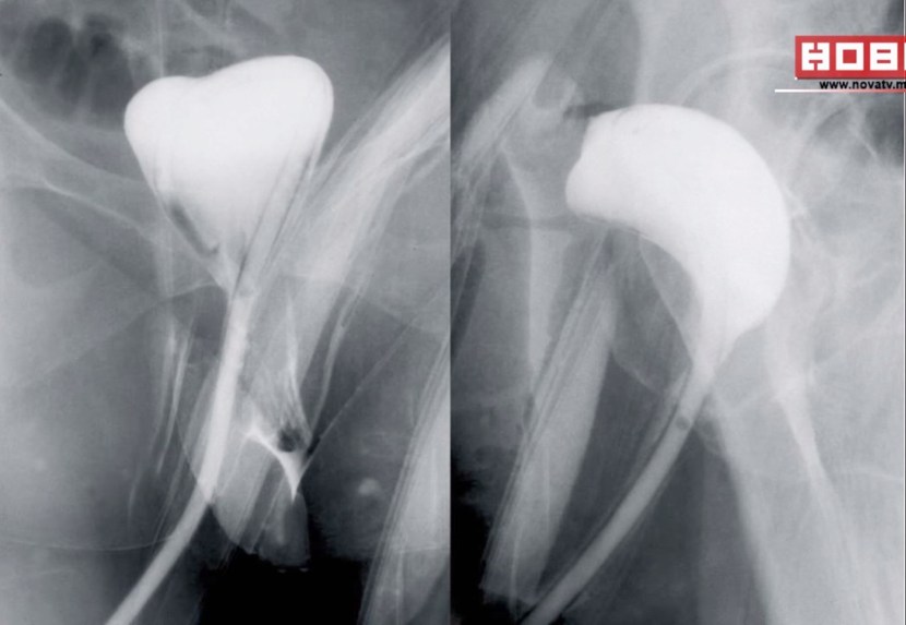 The location of the point G in women