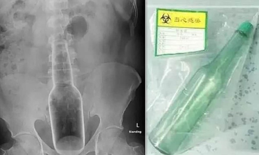 X -ray bottle in the rectum
