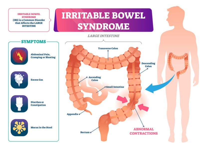 Irritation of the large intestine symptoms