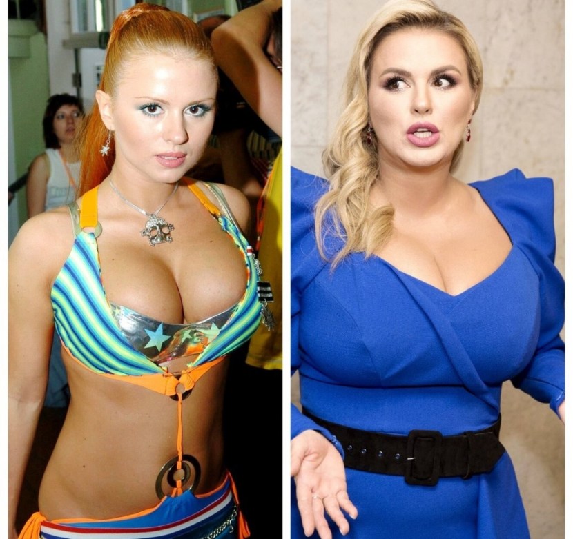 Anna Semenovich Liposuction