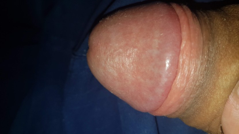 Old Uncut Thick Fat Mushroom Cockhead Dick