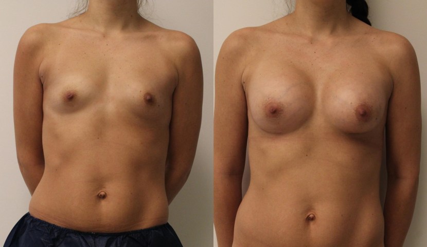 Breast enlargement in adolescents
