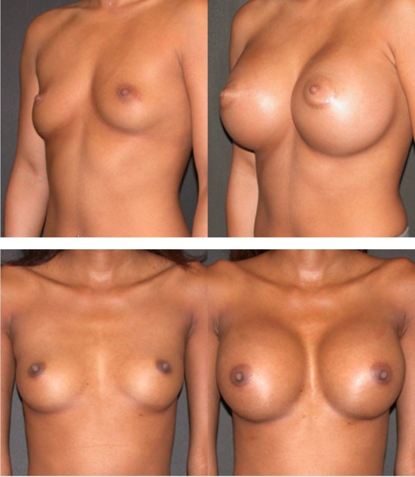 Beautiful female breasts with implants