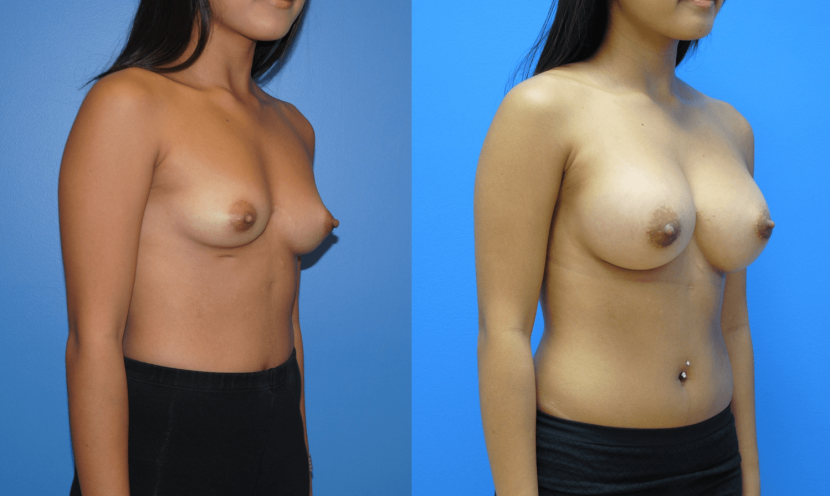 Elubicated female breasts