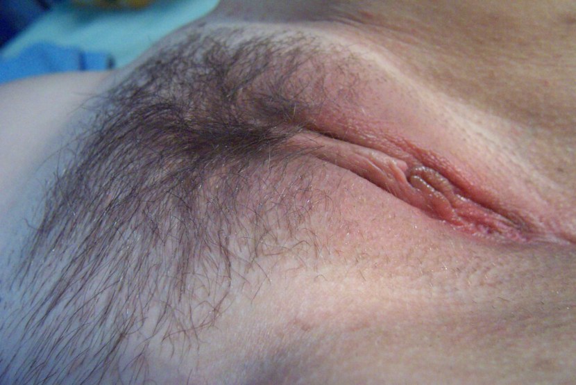 Pubic hair in women