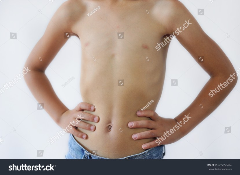 Muscular dystrophy of Emery Dreyfus