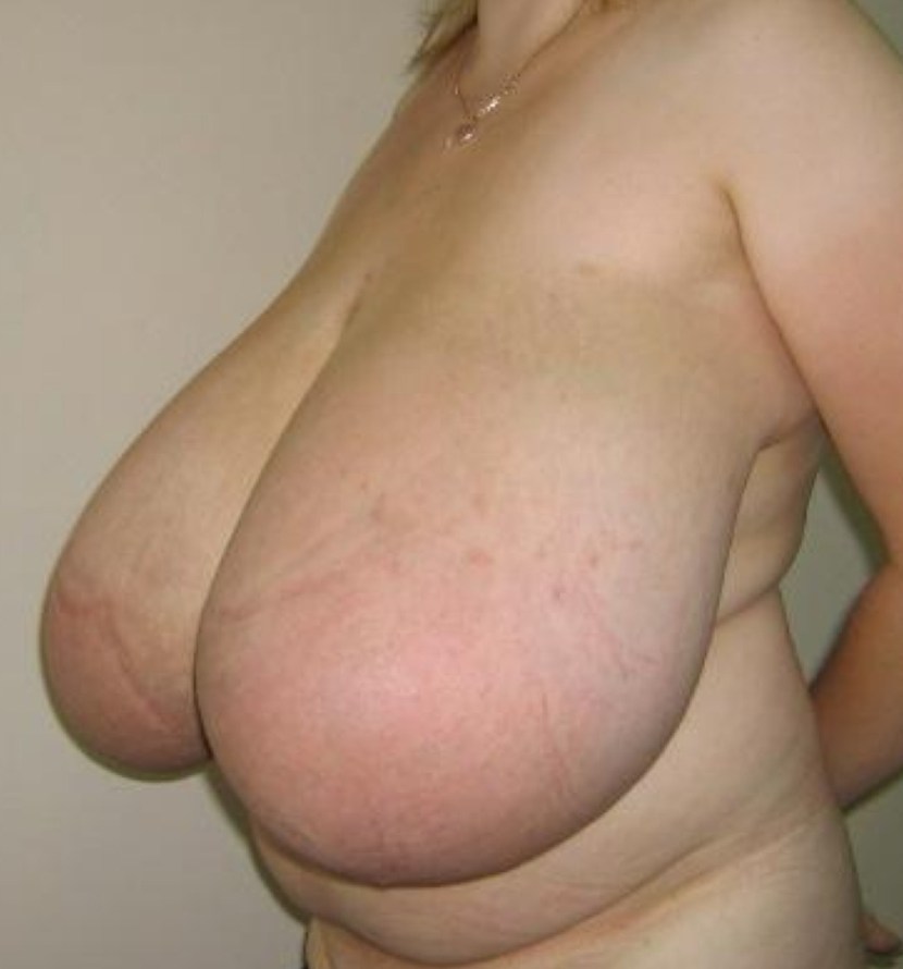 Naked tits gigantomastia