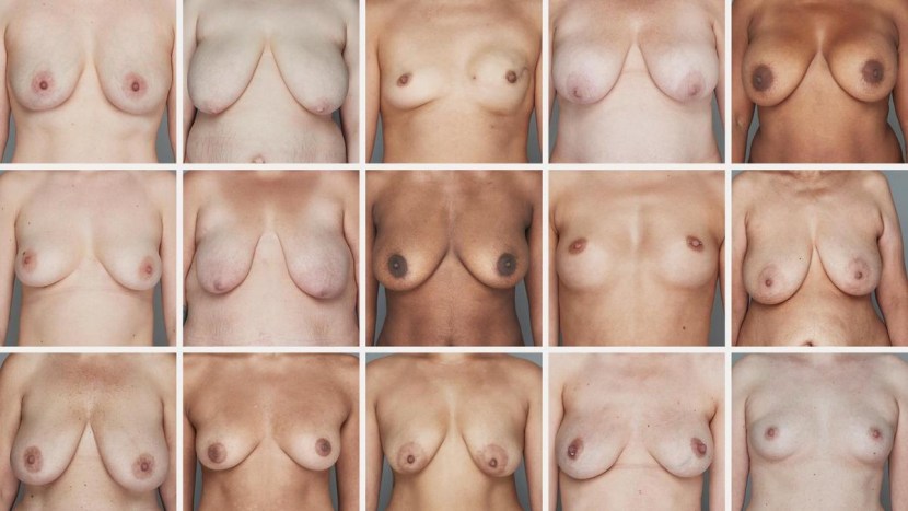 Naked female breasts with ptosis