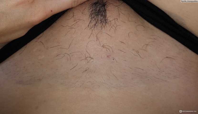 Scars after electric power