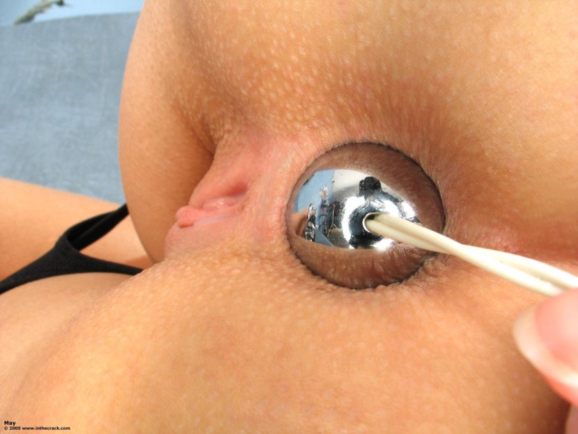 Metal balls in the anus
