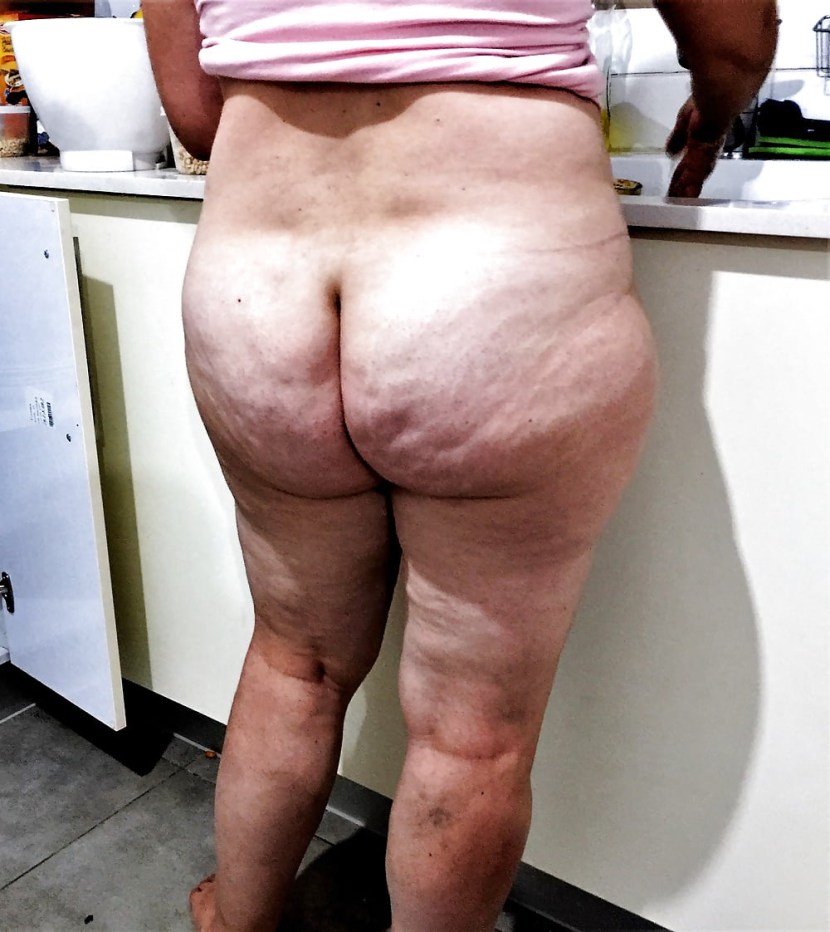 BBV Judy Grenny cellulite