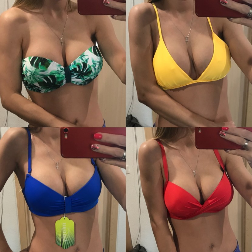 Mammoplasty before after