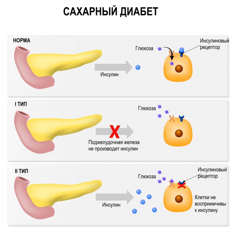 The causes of type 1 diabetes mellitus