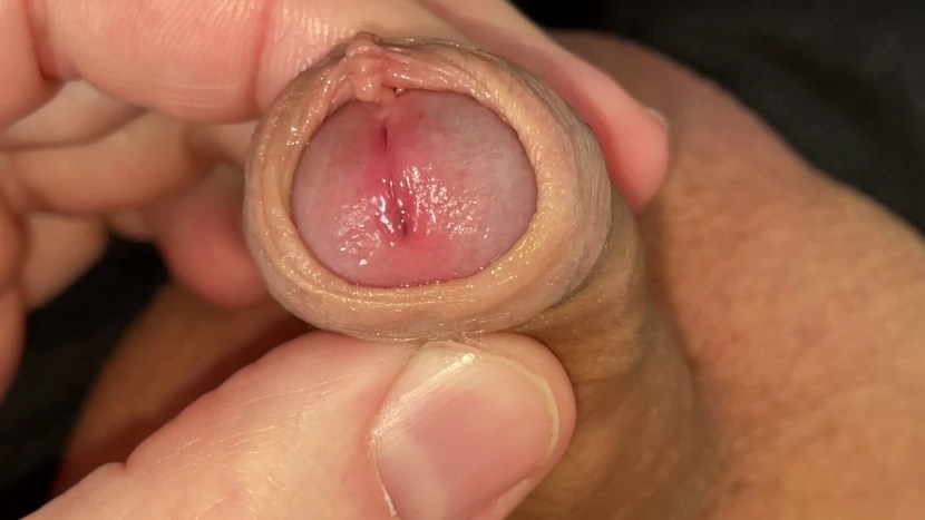 Members with the foreskin transsexual