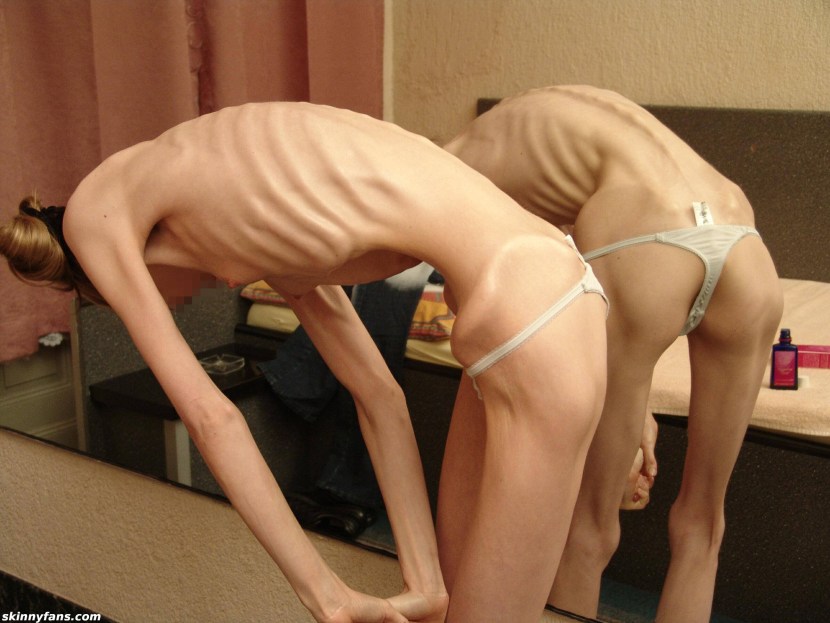 Naked women with anorexia