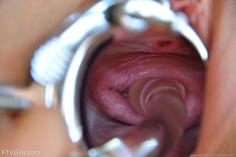 Prolapse vaginal loss
