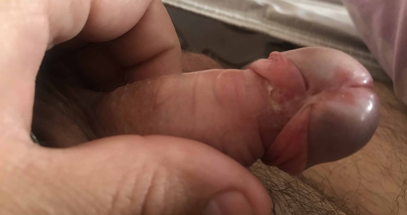 Penis seam after circumcision