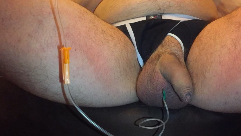 Saline Injection Breast Enlargement Video