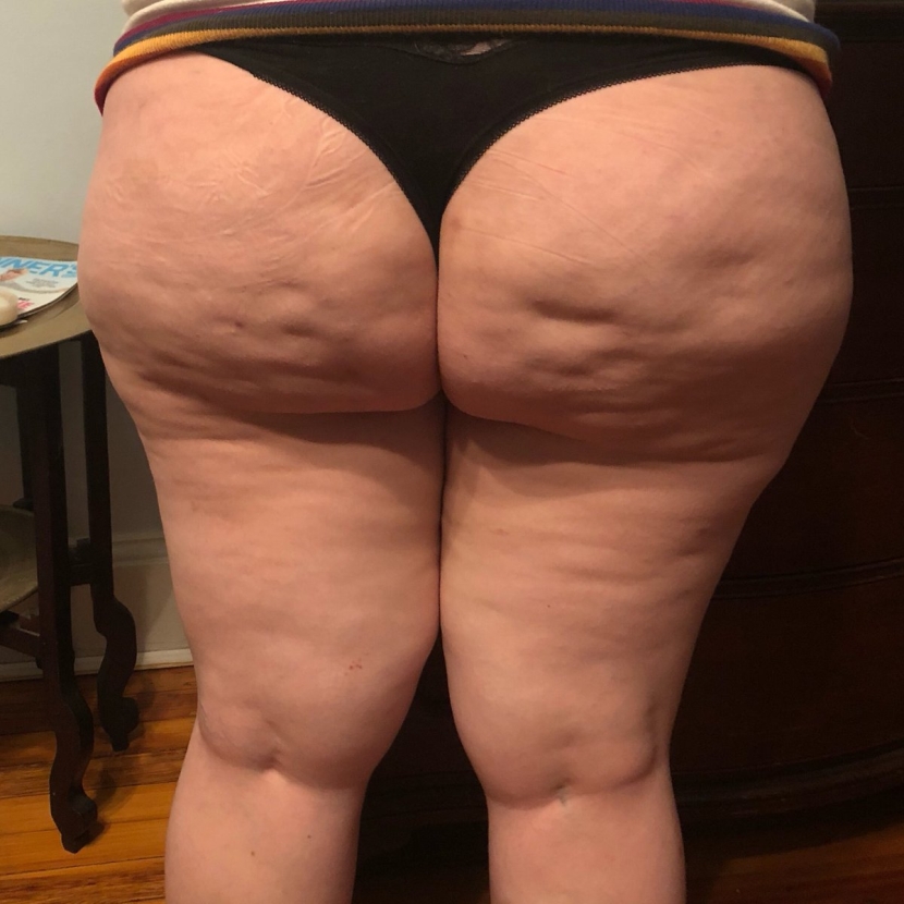 Big cellulite buttocks