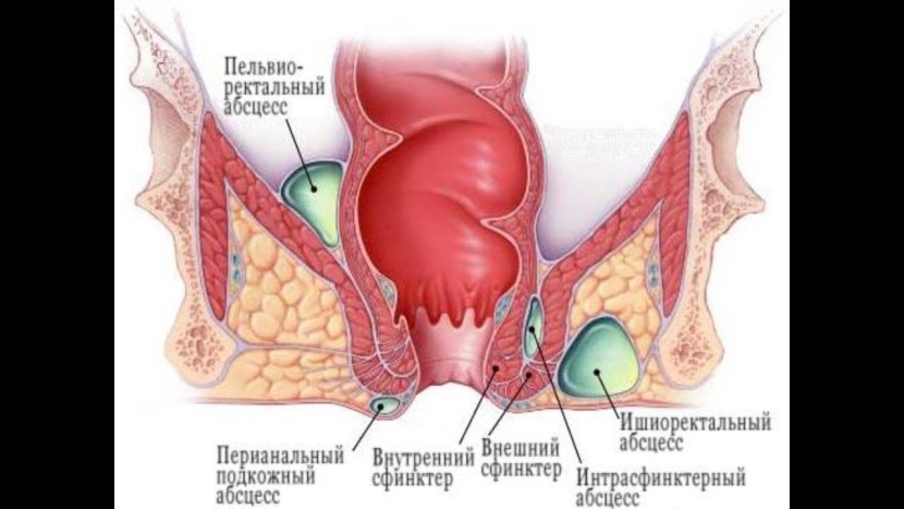 Acute purulent Ishiorectal paraproctitis